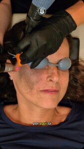 nevo de ota ou melasma