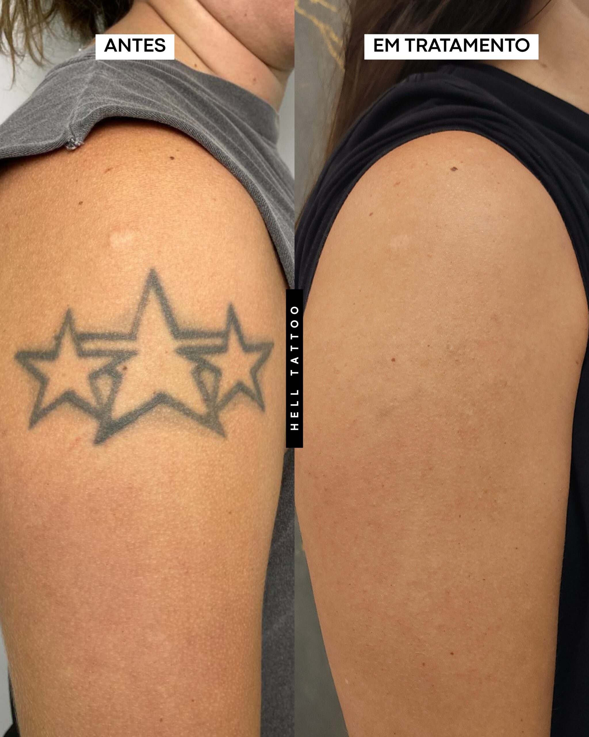 remover tatuagem de forma segura