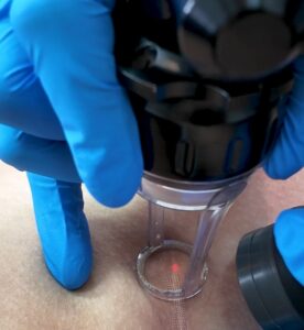 cicatriz-de-acne-cirurgia-ou-queimadura-quando-o-laser-pode-ajudar-02