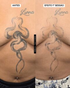 para-onde-vai-a-tinta-da-tatuagem-durante-a-remocao-a-laser