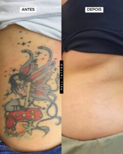 por-que-minha-tatuagem-nao-clareou-depois-da-primeira-sessao-02