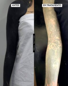 posso-remover-uma-tatuagem-que-ja-foi-coberta-por-outra-02
