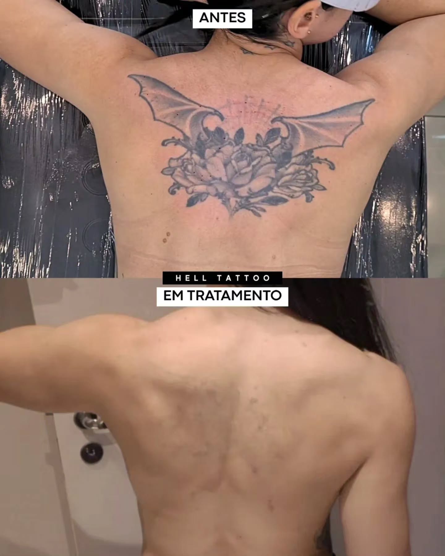 posso-remover-uma-tatuagem-que-ja-foi-coberta-por-outra