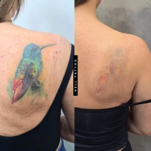 tatuagem azul remoção 02