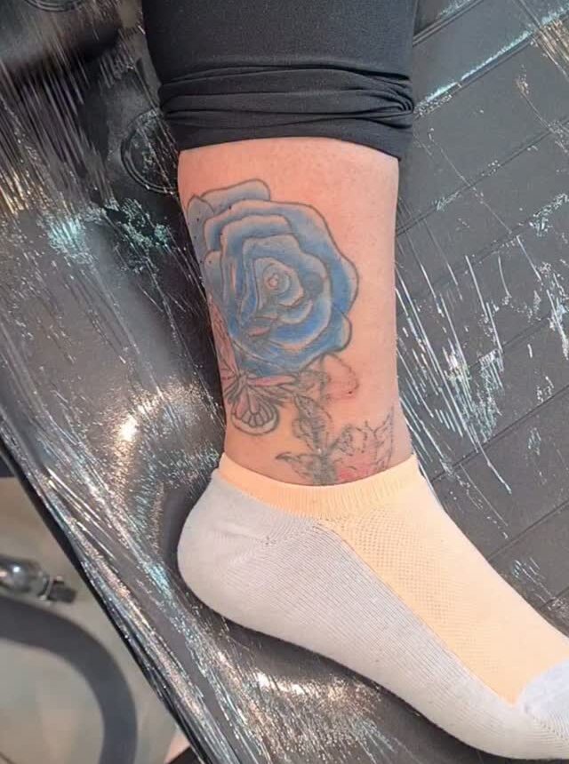 tatuagem azul remoção