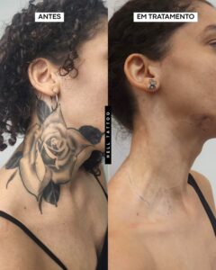 tatuagem-com-sombra-demora-mais-para-sair-01