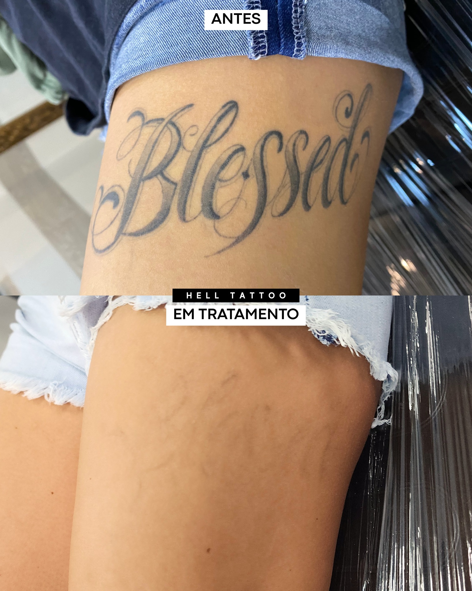 tatuagem-recente-pode-ser-removida-quanto-tempo-esperar-01
