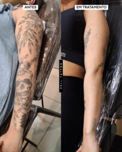 tatuagem-recente-pode-ser-removida-quanto-tempo-esperar