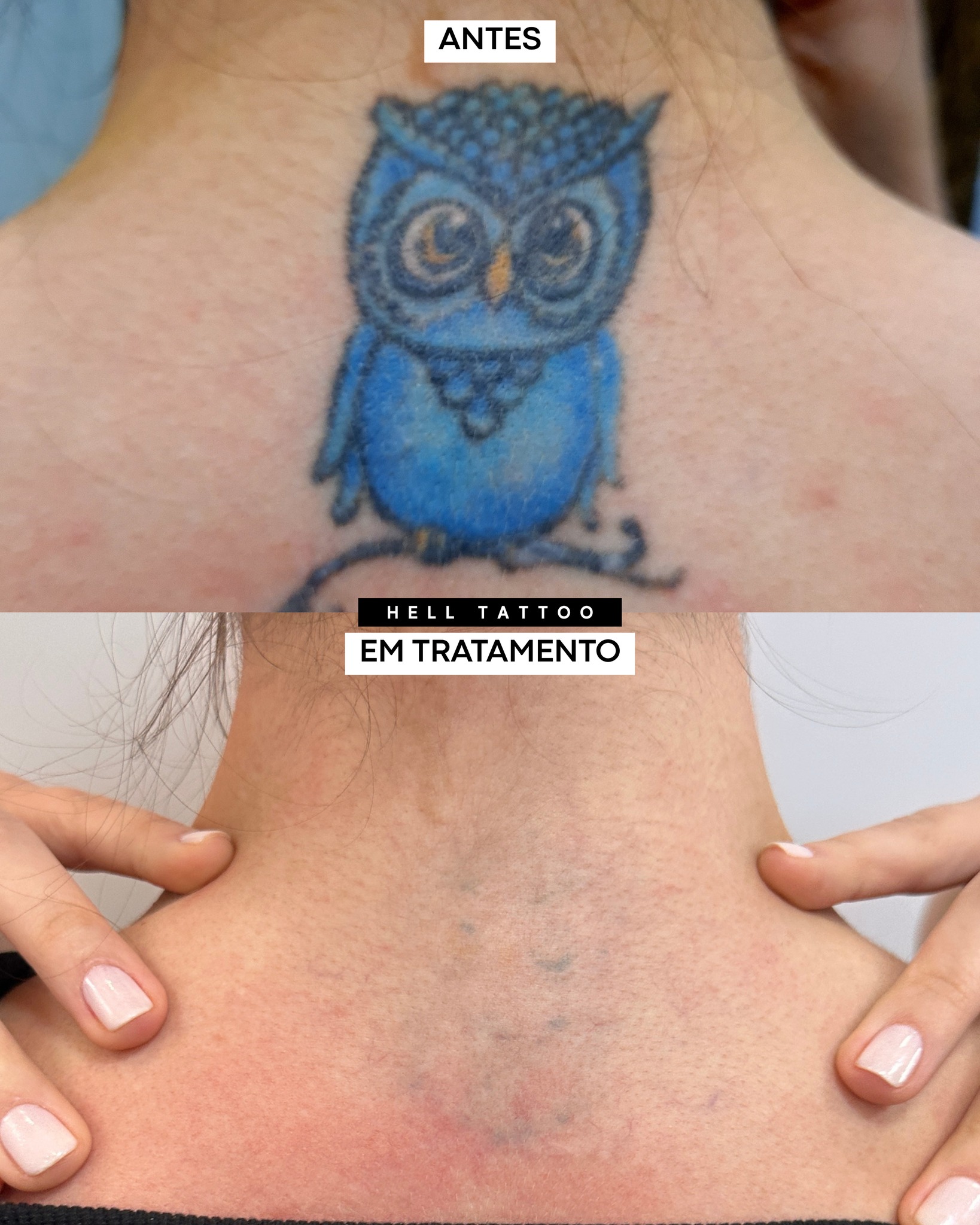 a-tatuagem-ficou-torta-o-laser-consegue-corrigir