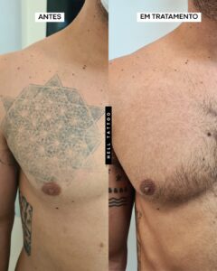 interromper a remoção de tatuagem