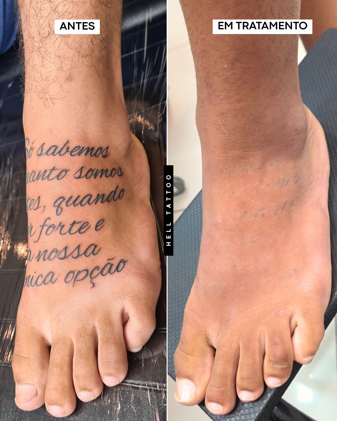 melhor-maneira-de-remover-uma-tatuagem-sem-deixar-cicatriz