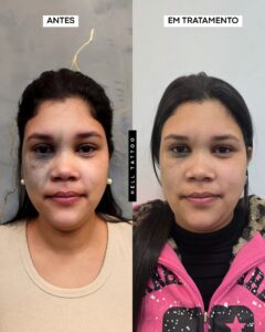 nevo de ota 01