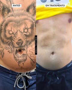 o-laser-consegue-remover-toda-a-tinta-de-uma-tatuagem