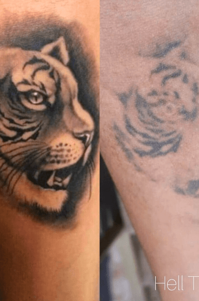 remoção de tatuagem de tigre no braço