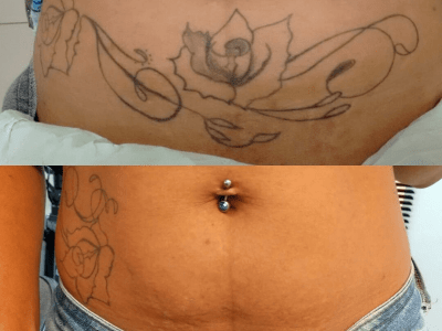 remoção de tatuagem na barriga