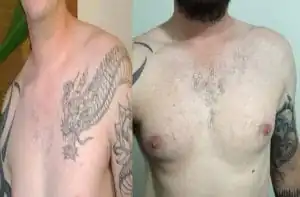 dicas para evitar cicatrizes apos remover tatuagem