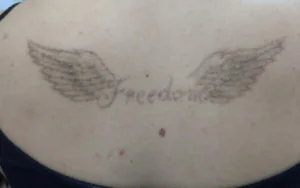 Q-Switched ND Yag: saiba mais sobre o laser e se livre das tatuagens! Q-Switched ND Yag