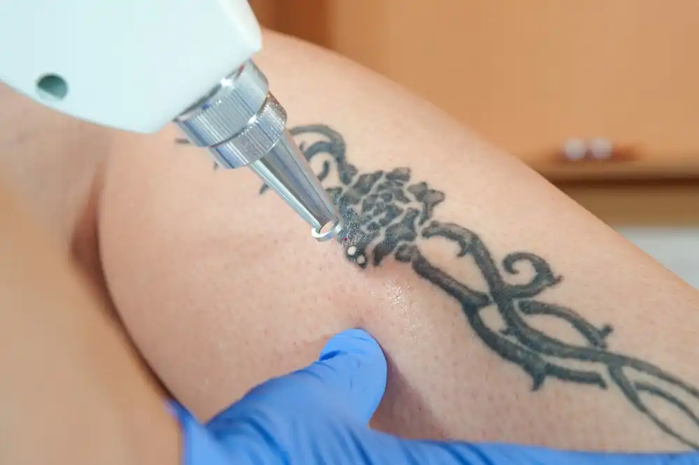 Formas de remover tatuagem: com profissionais ou remédios alternativos Duas formas de remover tatuagem