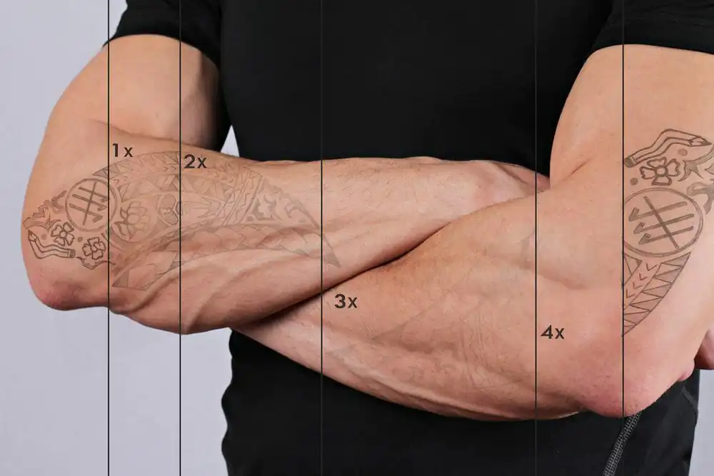 10 Dicas que você precisa saber antes de remover sua tatuagem