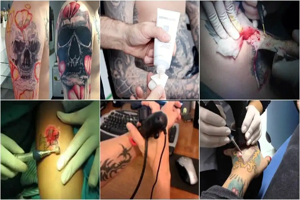 Métodos de remoção de tatuagem