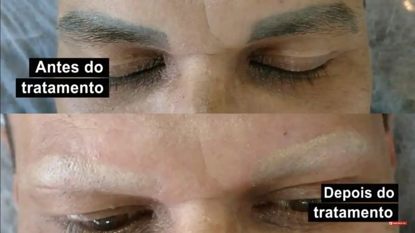 Como Remover Maquiagem Definitiva a Laser nas Sobrancelhas e Olhos? Remover Maquiagem Definitiva a Laser