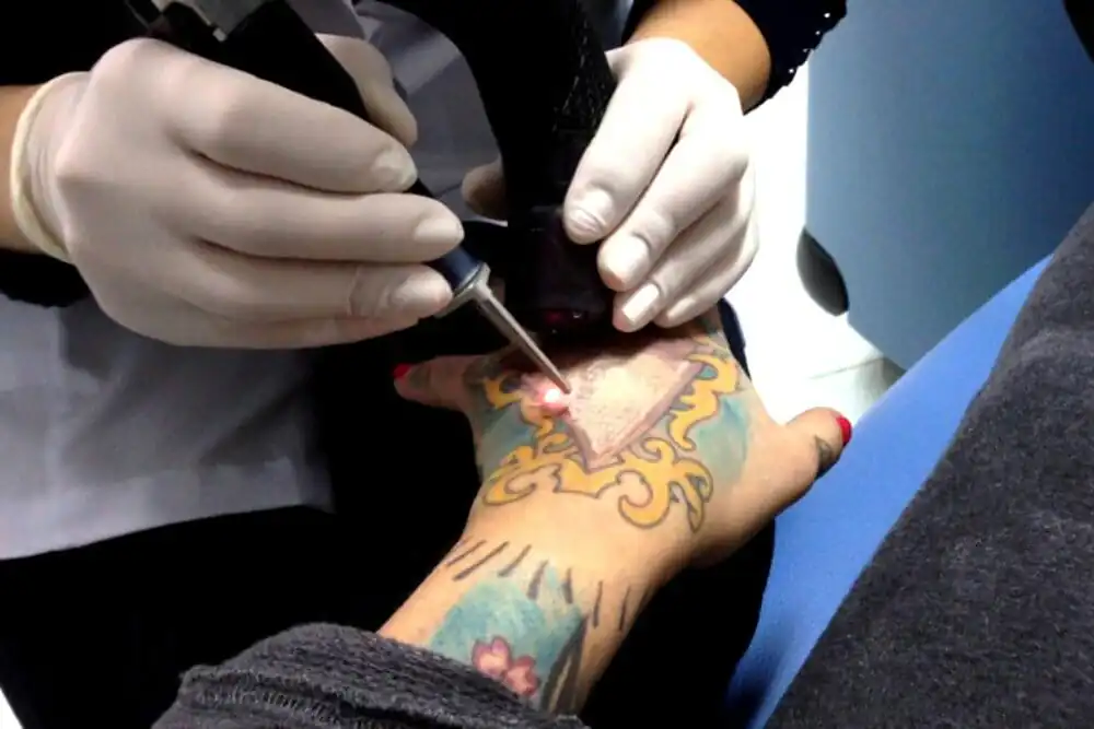 Laser ablativo e laser não ablativo: