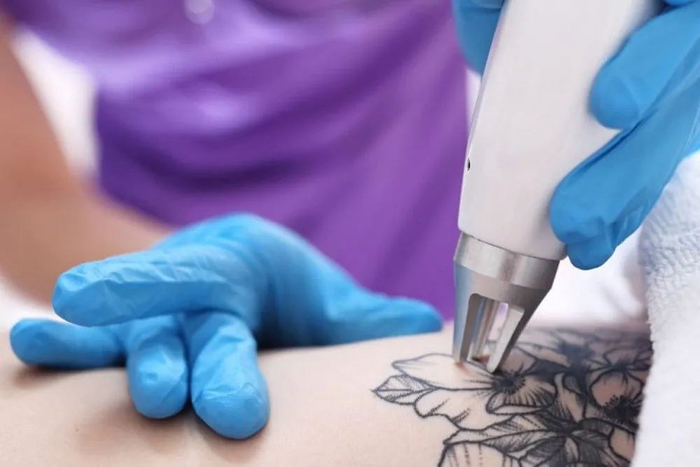 Dicas que podem ajudar a reduzir o custo de remoção de tatuagem reduzir custo de remoção de tatuagem