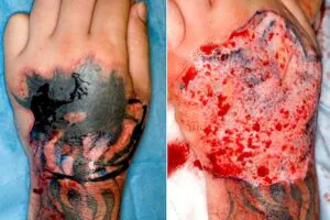 riscos associados a tatuagem