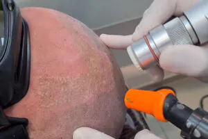 remoção de micropigmentação capilar