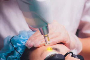 remover micropigmentação