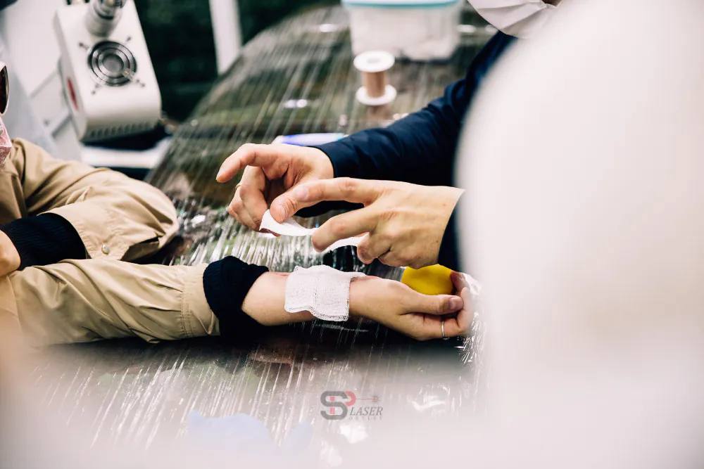 cuidados pos remoção de tatuagem a laser