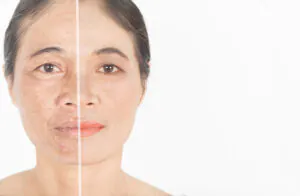 Laser Co2 Fracionado