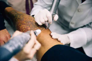 remoção de tatuagem com laser ruby