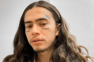 remoção de tatuagens em famosos