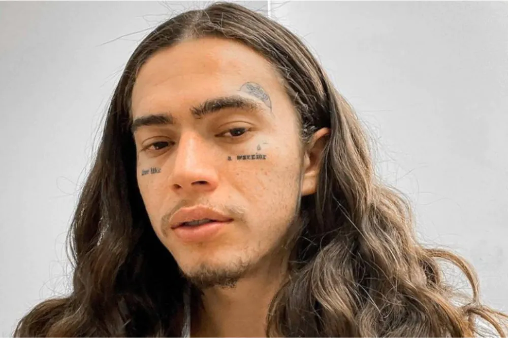 remoção de tatuagens em famosos