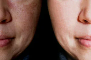 tratamento de melasma com laser