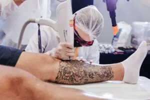 Remoção com Laser Q-Switched NdYAG
