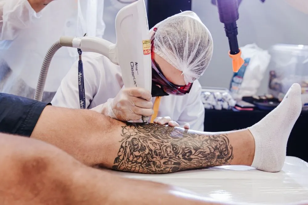 Remoção com Laser Q-Switched NdYAG