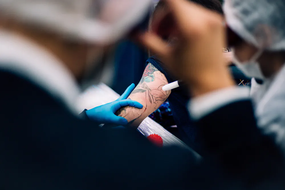 É possível acelerar o tratamento de remoção de tatuagem a laser? acelerar tratamento de remoção