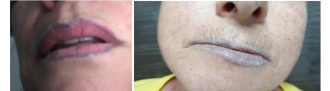 escurecimento paradoxal