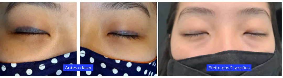 antes e depois de remoção de delineado olhos