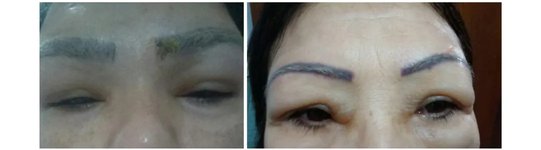 possiveis riscos pós remover sobrancelhas