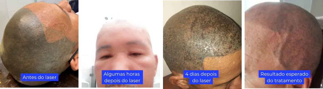 tratamento despigmentação capilar