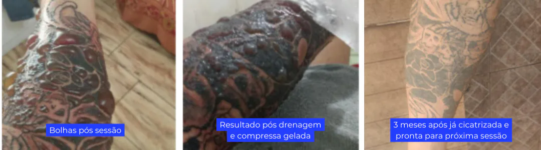 Bolhas pós remocao a laser