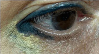 dificuldade na remoção de delineado