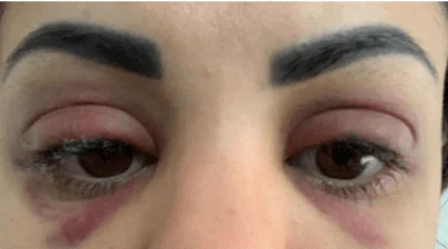 depois de remover delineado a laser