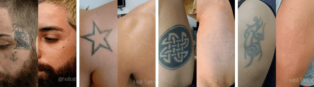 Cuidados pos remocao