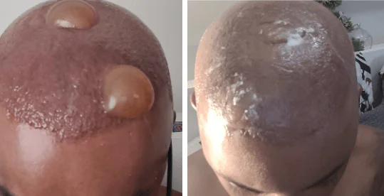 bolhas despigmentação capilar