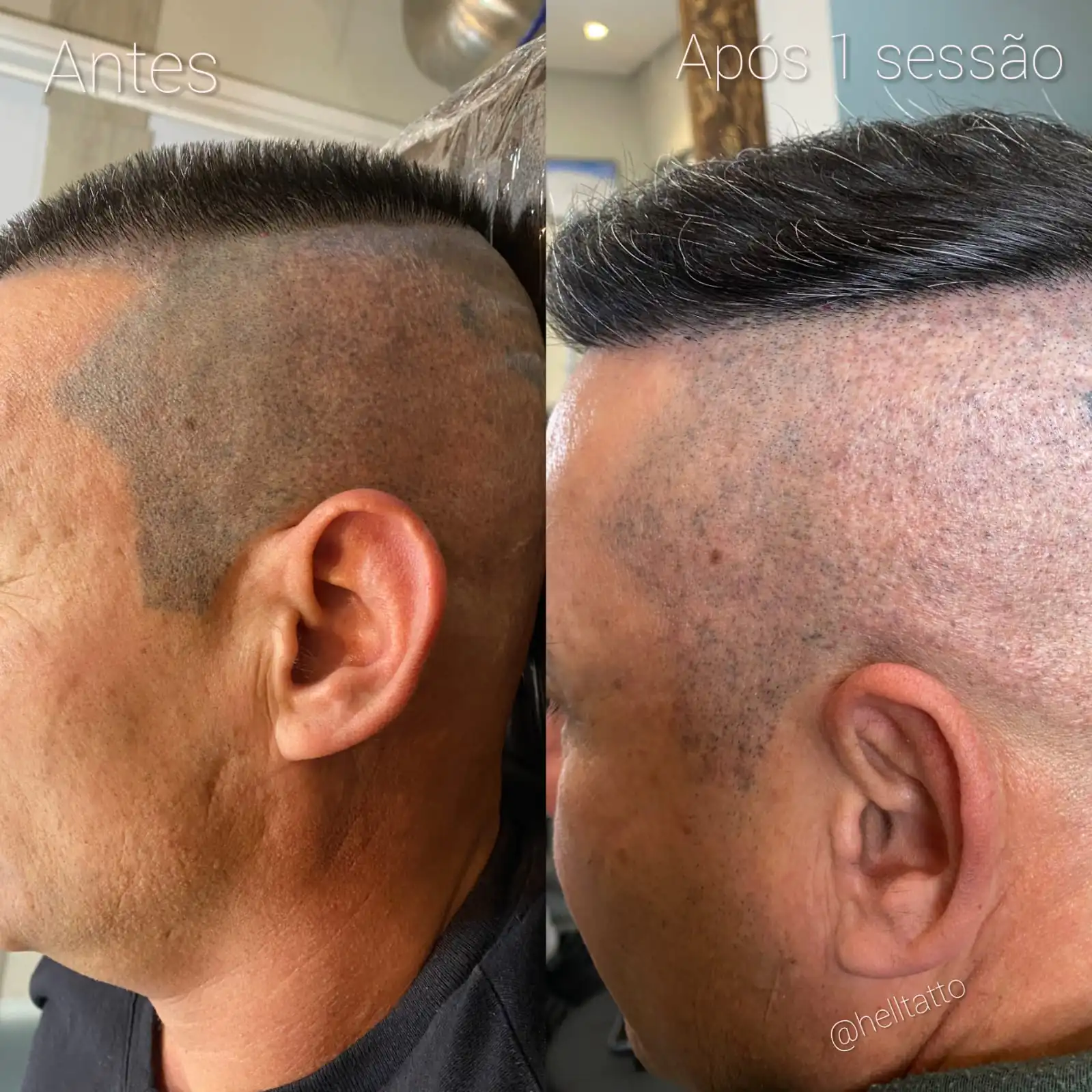 fez-micropigmentacao-capilar-e-nao-deu-certo-a-hell-tattoo-resolve