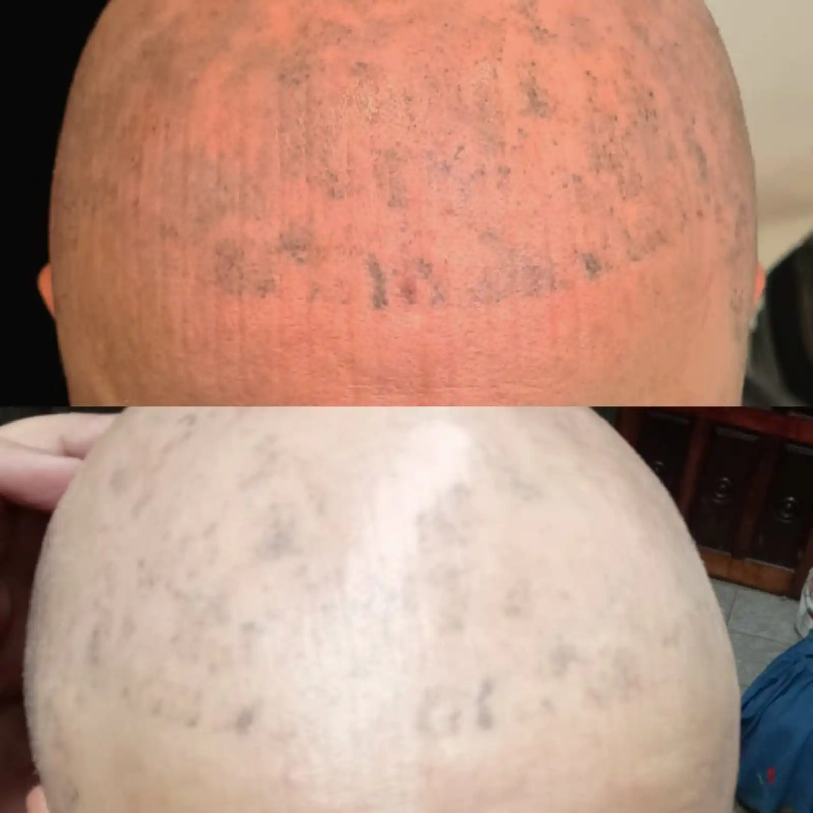 remoção de micro capilar